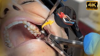 AMAZING Extraction of Wisdom Tooth Using Forceps [upl. by Keeton498]