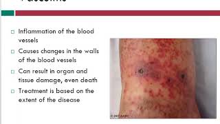 Vasculitis  Info About Vein Problems  WoundEducatorscom [upl. by Eesac]