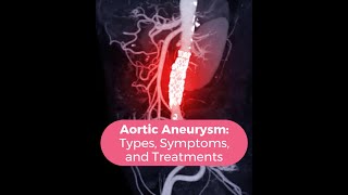 Aortic Aneurysm Types Symptoms and Treatments [upl. by Enitnatsnoc555]