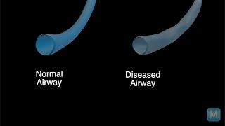 What Is COPD Chronic Obstructive Pulmonary Disease Part 2  Match Health [upl. by Rand]