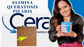 Como quitar los granitos de los brazos🤯Piel de gallina QUERATOSIS PILARIS [upl. by Zilvia]