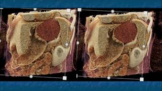 CT Evaluation of Primary Adrenocortical Carcinoma Part 2 [upl. by Ecadnarb]