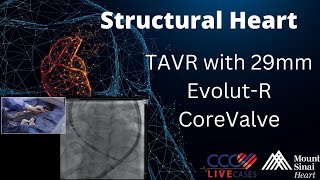 TAVR with 29mm EvolutR CoreValve  Structural Heart Sept 2017 [upl. by Oznole63]