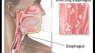 Candida Esophagitis [upl. by Ttergram624]