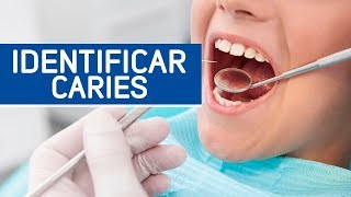 ¿Cómo puedo identificar las caries dentales [upl. by Lawler]