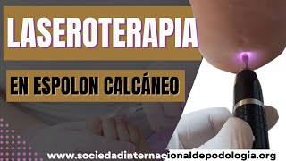 📣LASEROTERAPIA a Espolón Calcáneo Tratamiento Láser 💥 [upl. by Ebsen]