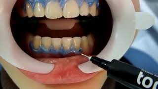 Using FGM Whiteness HP Maxx For In Office Bleaching Tooth Whitening [upl. by Zsamot484]