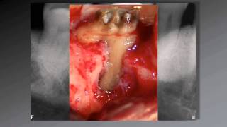 036 El uso de aumento en Endodoncia [upl. by Kerril]