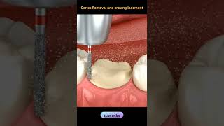 Caries Removal and Crown placementDentalhealth365 shorts shortsvideo dentist [upl. by Adhamh]