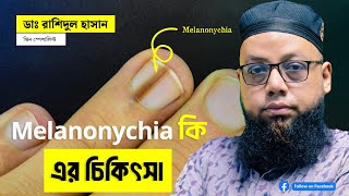 melanonychia নখের রং পরিবর্তন হয়ে যাওয়াকারন চিকিৎসা উদ্বিগ্নতার বিষয় [upl. by Ragouzis]