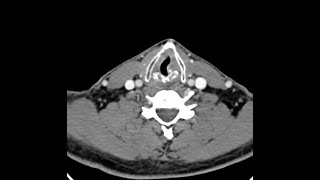 Teaching Rounds Locally Advanced Inoperable Oral Cancer [upl. by Gabriellia]