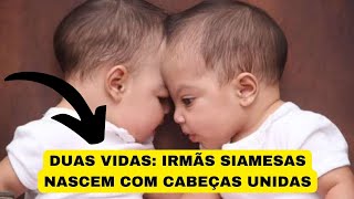 Duas vidas irmãs siamesas nascem com cabeças unidas [upl. by Frum602]