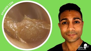 1526  Two Cases of Ear Wax Removal in Narrow amp Bendy Ears [upl. by Selemas]