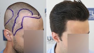 FUE Hair Transplant 2516 Grafts NW III A By Dr Juan Couto  FUEXPERT CLINIC Madrid Spain [upl. by Aiuhsoj]