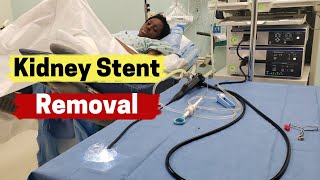 Kidney Stent Removal  What is Involved in Kidney Stent Removal [upl. by Ygief]