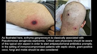 Ecthyma gangrenosum bei Pseudomonas aeruginosa Sepsis [upl. by Kory]