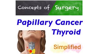 Thyroid papillary cancer Most Simplified Approach to Management [upl. by Htebazle]