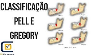 Classificação de Pell e Gregory para a posição dos 3os molares [upl. by Inalaehon73]