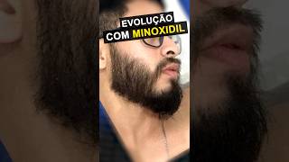 RESULTADO COM MINOXIDIL impressionante barba minoxidil [upl. by Enitsuga108]