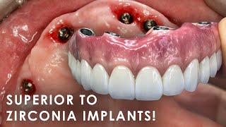 A Superior Option to Zirconia Implants [upl. by Neik663]