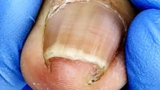 Extremely curly ingrown toenails causing torment to the toes【Xue Yidao Pedicure】 [upl. by Erej]