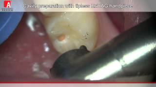 Caries Removal amp Cavity Preperation with Fotona Lightwalker ErYAG Laser [upl. by Nitsua442]