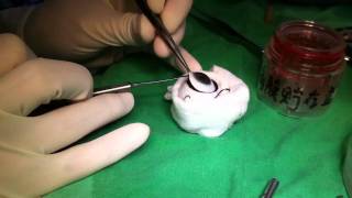 How to harvest cornea button [upl. by Ramar]