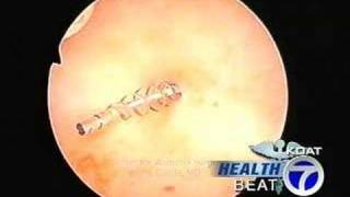 Heathbeat  Essure Procedure Alternative to Tube Tying [upl. by Maximilianus]