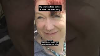 My swollen face before and after thyroidectomy After thyroid surgery for thyroid cancer and a neck [upl. by Eanyl]