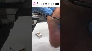 Satisfying corn and callua removal by podiatrist in clinic by cutting with scalpel [upl. by Anerhs]