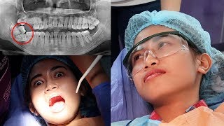 wisdom impacted teeth removal masakit ba [upl. by Allys]