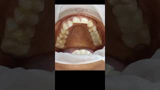 Cement retained g cam bridge for upper molar replacement with single piece dental implants Chennai [upl. by Sibby797]