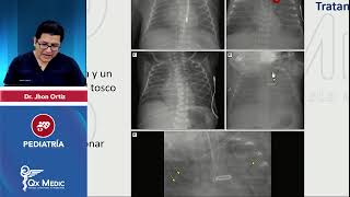 Displasia broncopulmonar PEDIATRÍA INDICE DESCRIPCIONFACT RIESGO CLINICATTO QX MEDIC 2023 [upl. by Rehsa768]