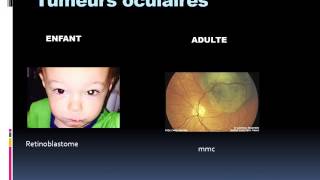 OPHTALMOLOGIE Tumeurs oculaire [upl. by Fredrika]