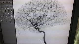 Cerebral Angiography [upl. by Aneerol]