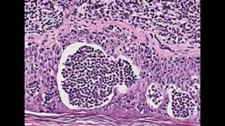 Histopathology SkinMycosis fungoides [upl. by Lauhsoj]