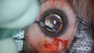 Intraocular Lens exchange SurgeryAlcon Vivitysurgeonlife ophthalmologist youtubeshorts vision [upl. by Llertac]