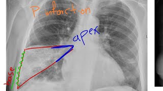 Focal lung lesion chest Xray in Kurdish [upl. by Warfeld412]