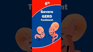 Severe GERD Treatment  in Bangalore  JP nagar  drtulip  acidreflux [upl. by Veljkov]