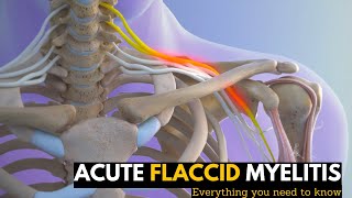 Acute Flaccid Myelitis Everything You Need To Know [upl. by Rizas192]