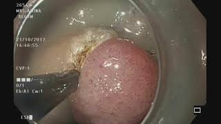 ESD for adenomatous gastric polyp [upl. by Aronoff]