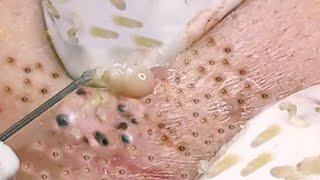 NEW Pimple Popping Compilation  Blackheads removal  Pimple removal vids of 2021 [upl. by Yecrad448]