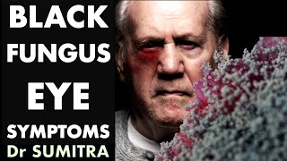 Black Fungal infection  EYE symptoms of Mucormycosis  Dr Sumitra [upl. by Aenet513]