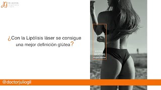 Lipolaser vs liposuccion Diferencias Riesgos ¿ideal para modelos Testimonio [upl. by Croft]