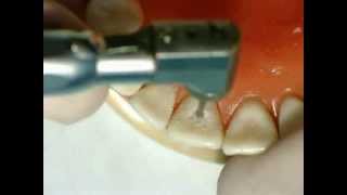 Palatal pit cavity preparation for amalgam  GV Black  Dr Ahmed Sleibi [upl. by Corly947]