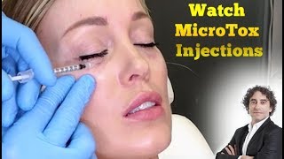 Watch MicroTox Eye InjectionsBefore and After [upl. by Englis]