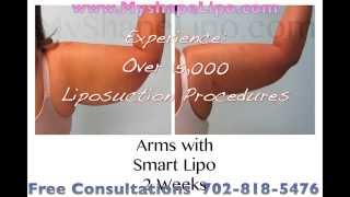 Arms Liposuction Before and After MyShape Lipo [upl. by Eaver]