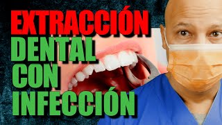 EXTRACCION DENTAL con INFECCION 👈 [upl. by Airt]