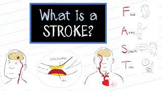 What is a Stroke HealthSketch [upl. by Anipsed]