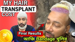 Hair Transplantৰ Final Result  Bandage খুলোতে কিয় হল এনেকুৱা কিমান খৰচ পৰিছিল Transplantত [upl. by Tteve235]